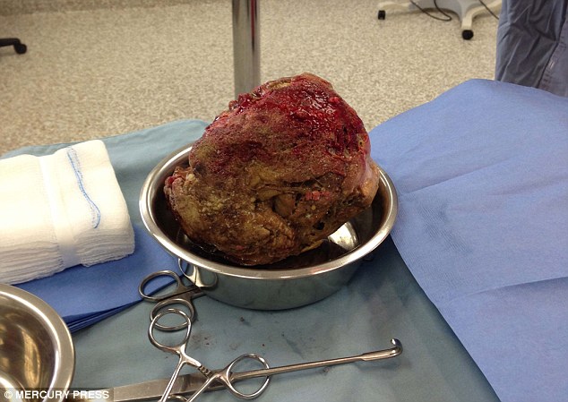 However, it was discovered after surgery that he had swallowed a massive lump of glue that was removed 