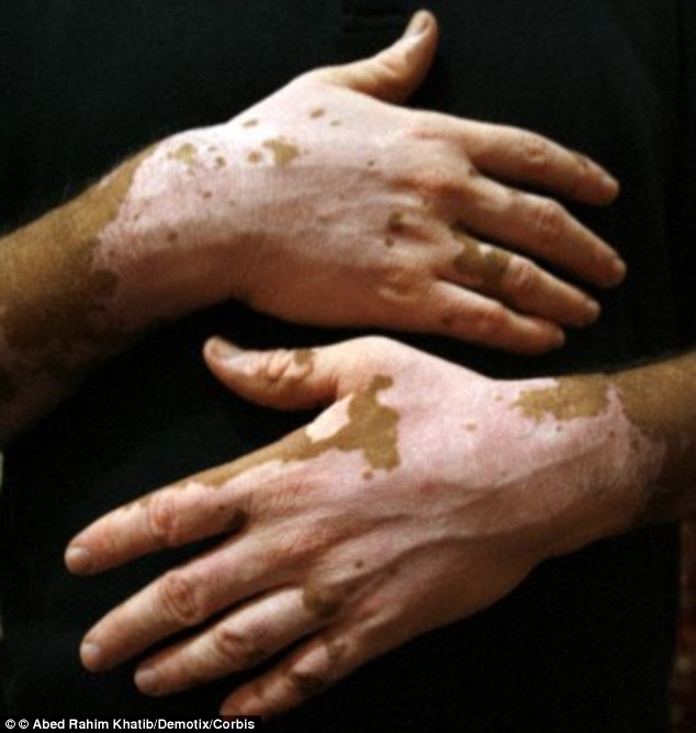 Vitiligo is a long-term condition that causes pale, white patches to develop on the skin die to the lack of melanin. This stock image shows the hands of someone with vitiligo